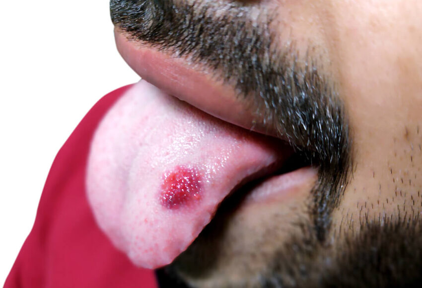 Oral Cancer Treatment in Pune