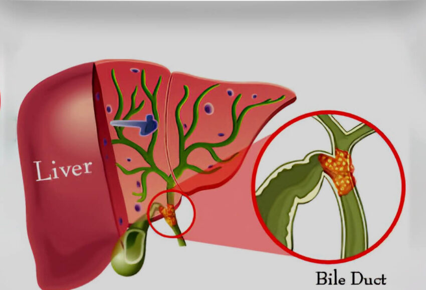 Bile Duct Cancer Treatment in Pune