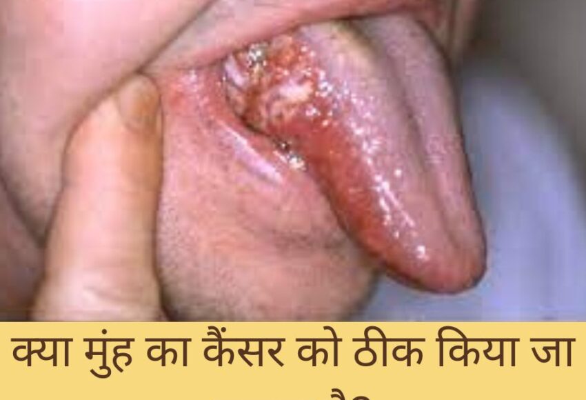 क्या मुंह के कैंसर को ठीक किया जा सकता है? | prolife cancer centre