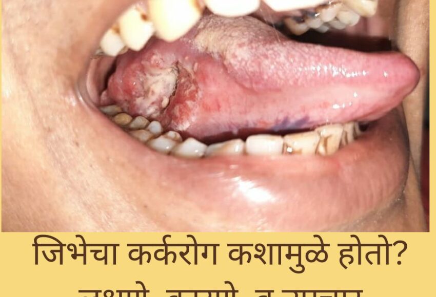जिभेचा कर्करोग कशामुळे होतो? लक्षणे, कारणे, व उपचार | Prolife Cancer Centre