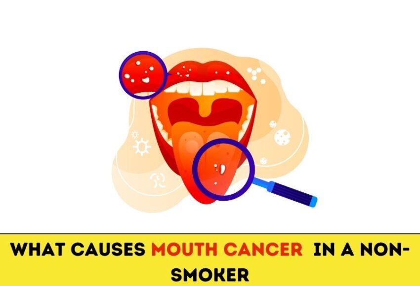 What Causes Mouth Cancer In A Non-Smoker