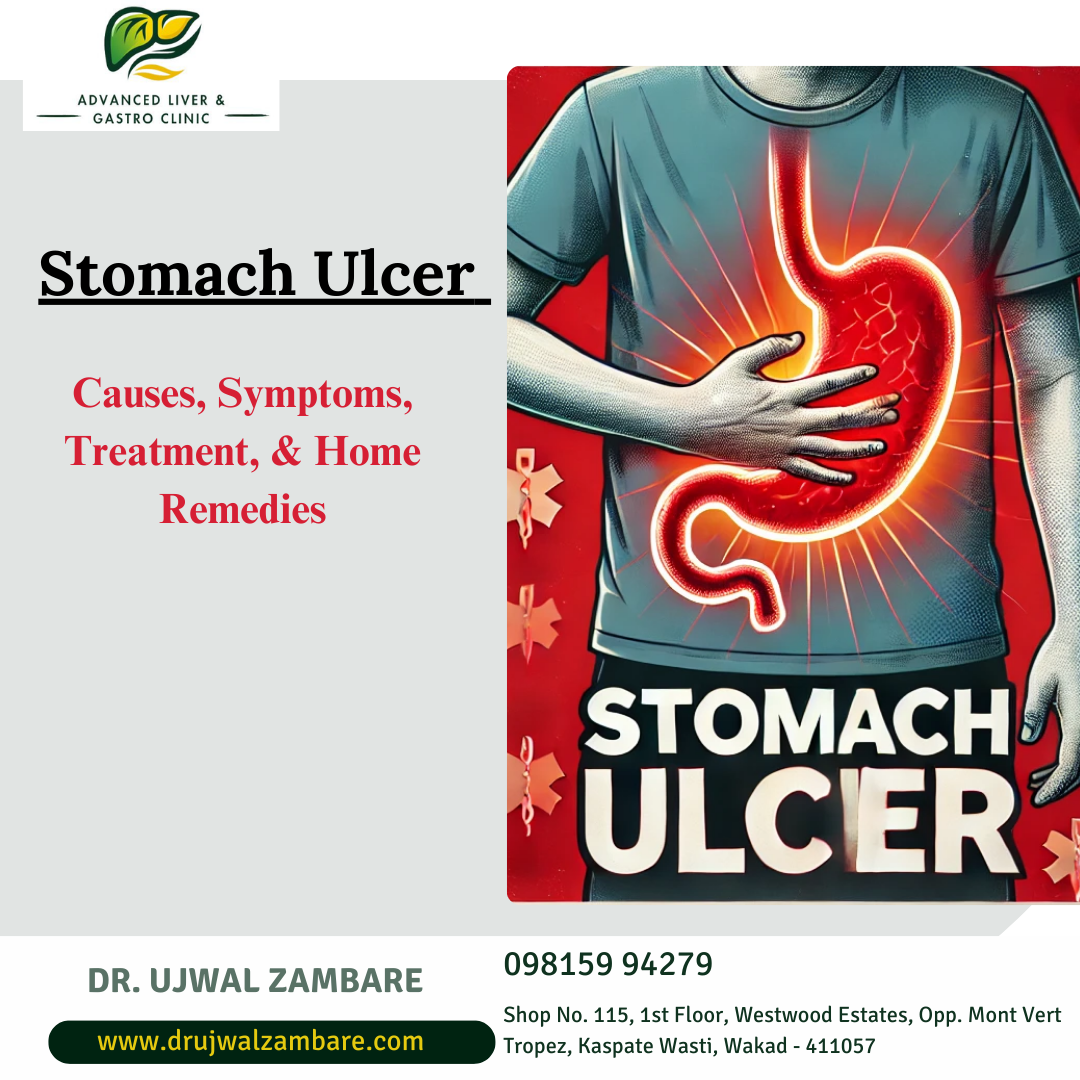 Stomach Ulcers Cause & Symptoms