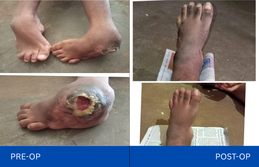 19 yr old girl with foot deformity and non healing ulcer