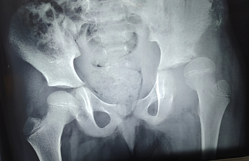 Hip Joint4 years old girl with left hip joint subluxation with coxa valga (post septic) underwent left hip Open Reduction and proximal femur varus derotation osteotomy and hip spica