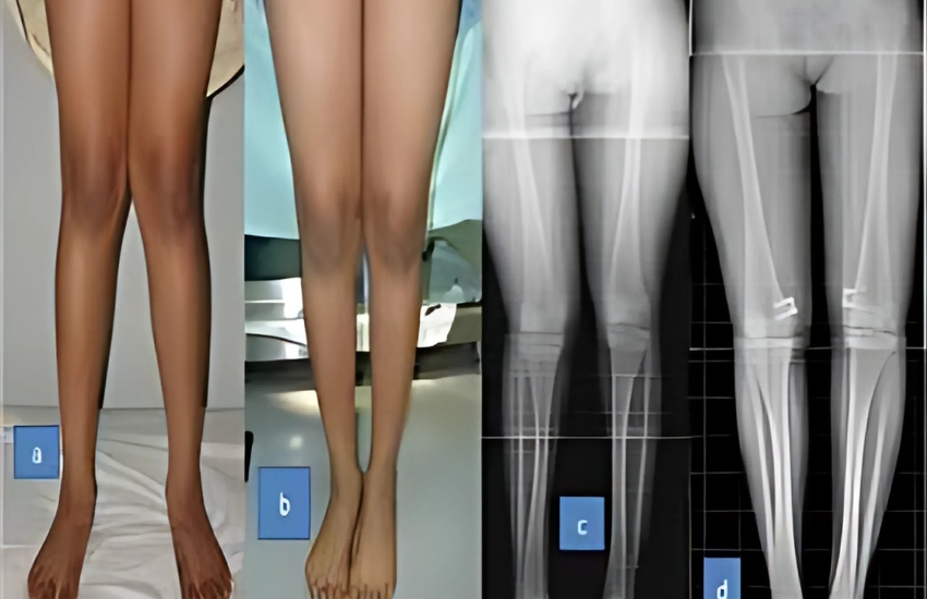 GENU VALGUM PREOP AND POST OP IMAGESBilateral genu valgus deformity correction with osteotomy