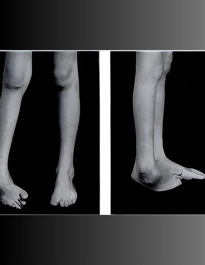 Bone-and-soft-tissue-tumors-400x516