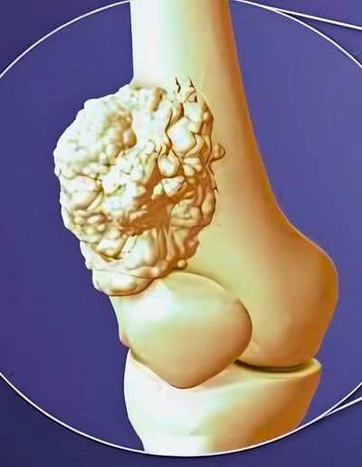Bone_and_soft_tissue_tumors1-400x516
