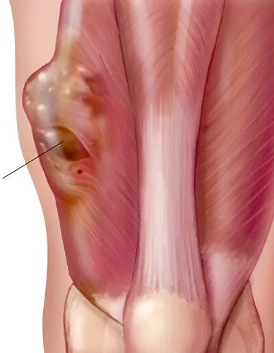 Bone_and_soft_tissue_tumors_31-400x516