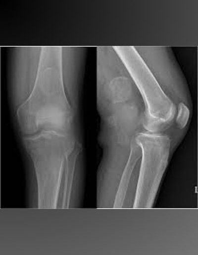 Bone_and_soft_tissue_tumors_41-400x516