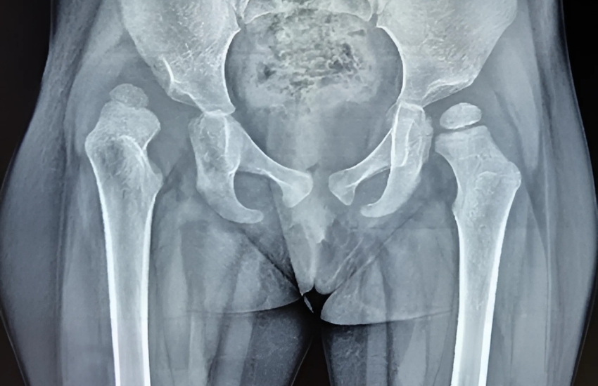 DDH xray3 years old child with right hip Dysplasia with dislocation  underwent open reduction and femoral shortening and varus derotation osteotomy