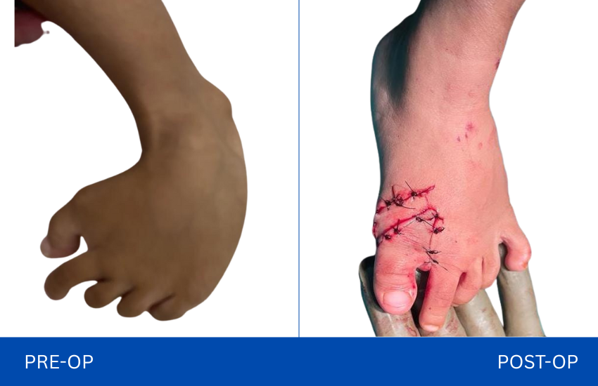 Foot deformity