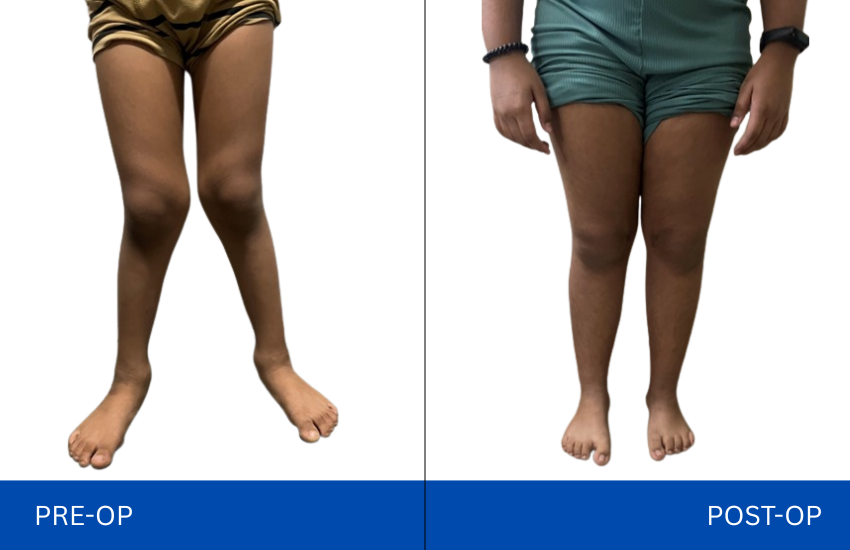 Genu valgum deformity