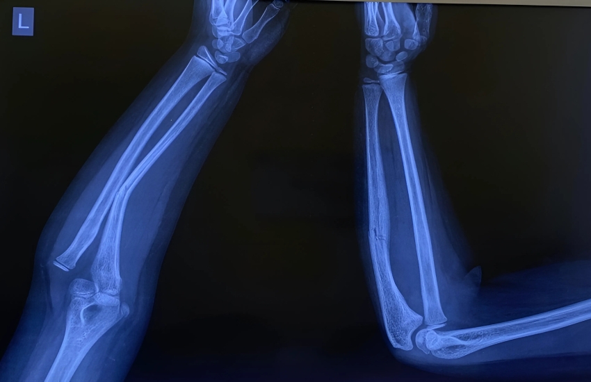 MONTEGGIA FRACTURE DISLOCATIONMonteggia Fracture dislocation treated with plaster without surgery