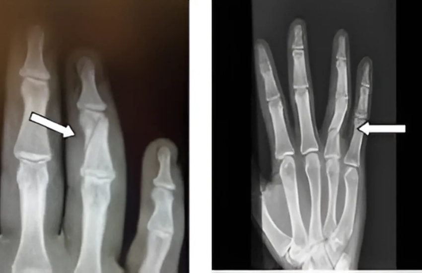 Middle Phalanx FractureNeglected Middle Phalanx Fracture managed with minimally invasive surgery with mini JESS Fixator