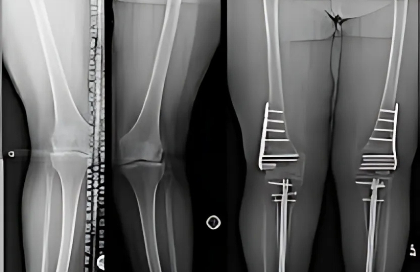 Bone and soft tissue tumorsMinimally invasive surgery to correct the deformity without cutting the bone with single screw (day care surgery)