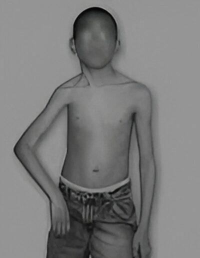 OBPP_and_other_neuromuscular_palsy_of_upper_and_lower_limb_41-400x516