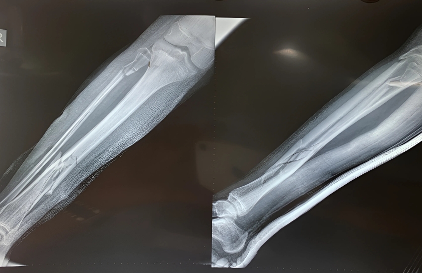 Open Tibia FractureOpen Tibia Fracture managed with elastic nail and JESS fixator