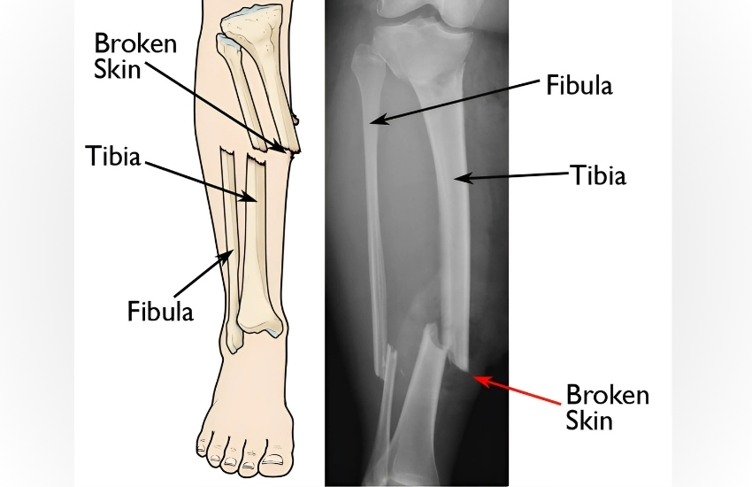 Road Traffic Accident with open woundRoad Traffic Accident with Open tibia fracture advised amputation elsewhere saved his leg with multiple surgery