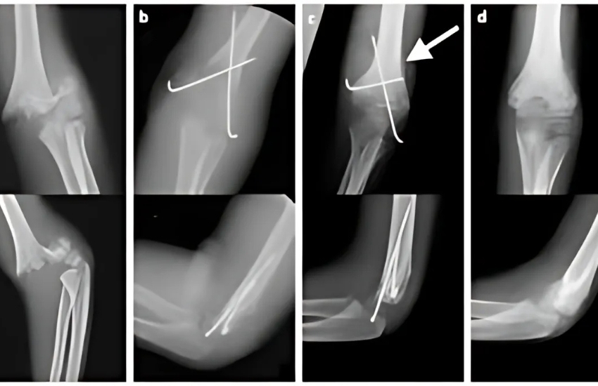 Supracondylar FractureThis is supracondylar fracture in a 5yr old child after slip and fall while playing ( x ray before surgery )