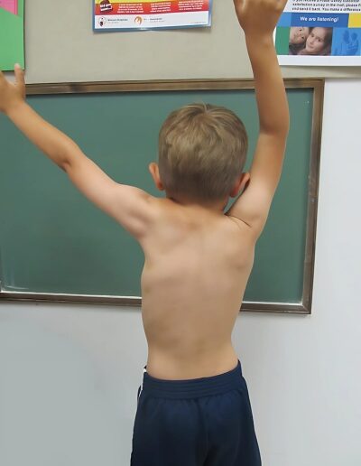 Torticollis-Sprengel-shoulder-and-other-scapular-deformities-1-400x516