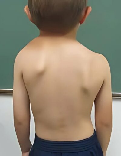 Torticollis-Sprengel-shoulder-and-other-scapular-deformities-400x516