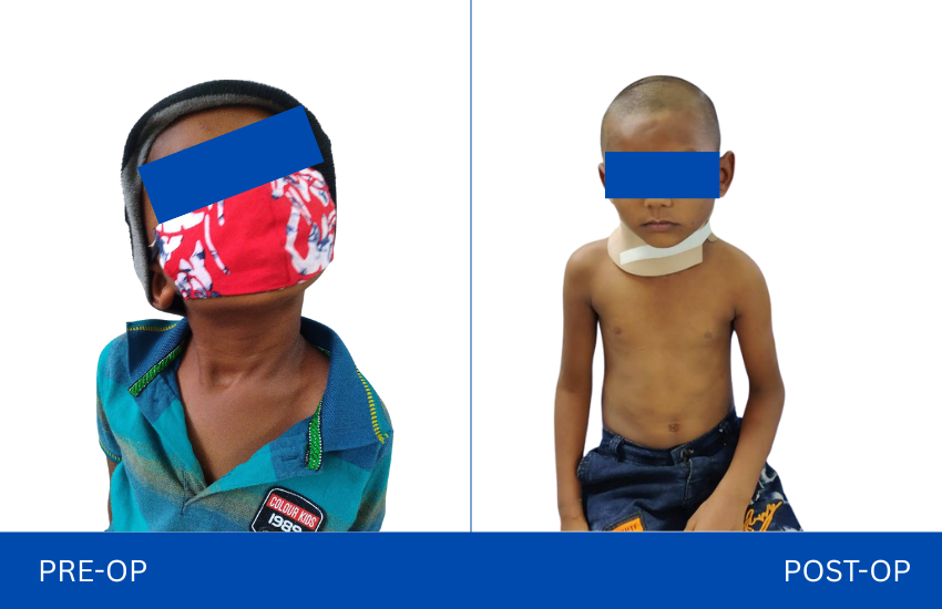 Torticollis surgery (1)