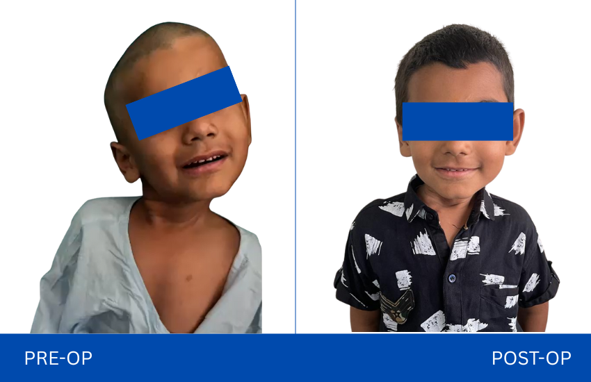Torticollis surgery
