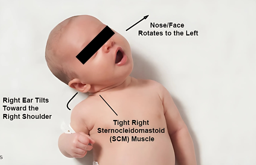 TorticollisTorticollis before surgery and after surgery pictures