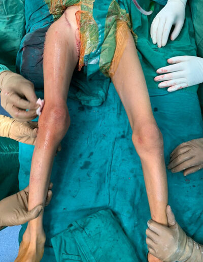 cerebral-palsy-after-correction-400x516