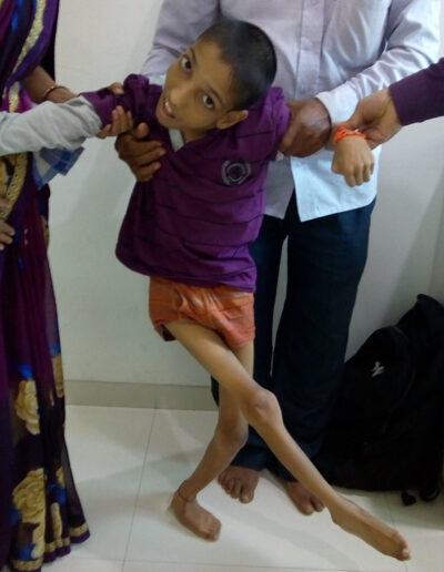 cerebral-palsy-gait-disorders-treatment-in-vadodara-400x516