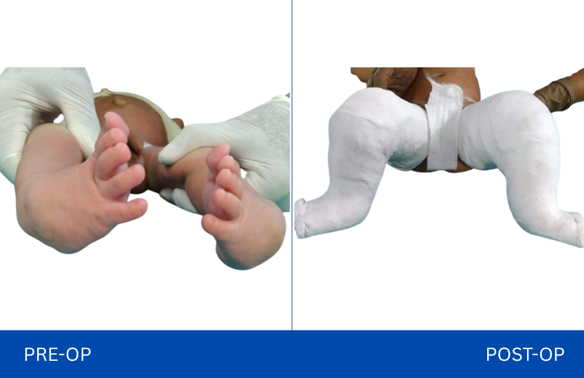 clubfoot in New Born child