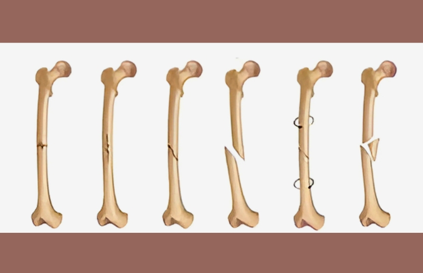 Road Traffic AccidentAFTER ankle and femur fixation surgery