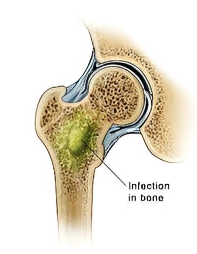 joints-and-bones-infection-gallery-1-400x516