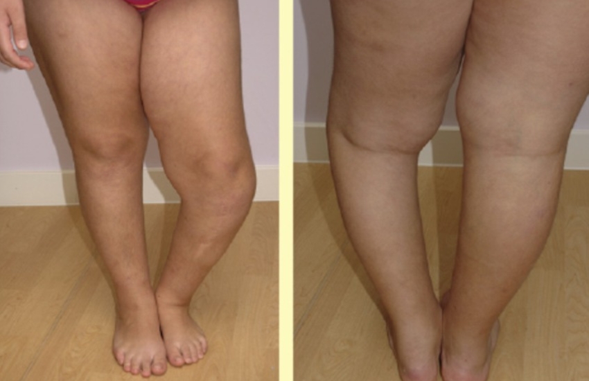 Deformityknee deformity (blount disease) genu varum left side