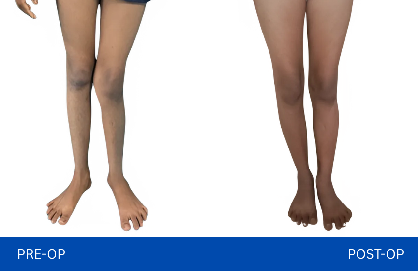 left side deformity (GENU VALGUM)