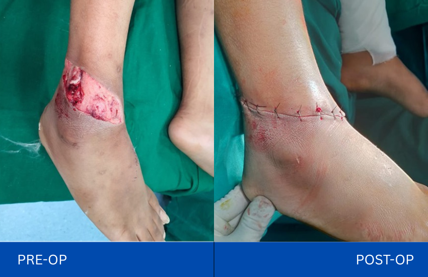 open ankle fractures pre op