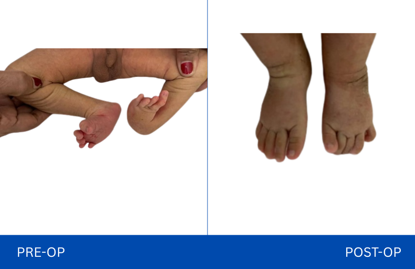 pre op (NEW BORN with bilateral clubfoot deformity)