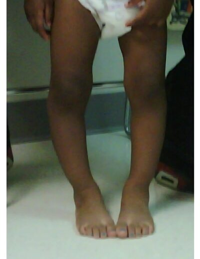 upper-lower-limb-deformity-correction-treatment-1-400x516
