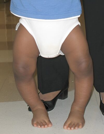 upper-lower-limb-deformity-correction-treatment-2-400x516 (1)