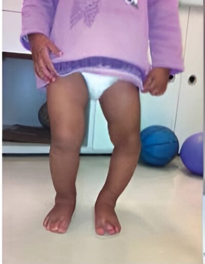 upper-lower-limb-deformity-correction-treatment-3-400x516