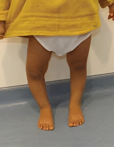 upper-lower-limb-deformity-correction-treatment-4-400x516