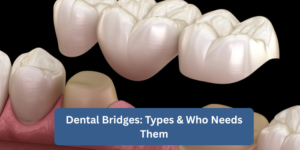 Dental Bridges: Types & Who Needs Them