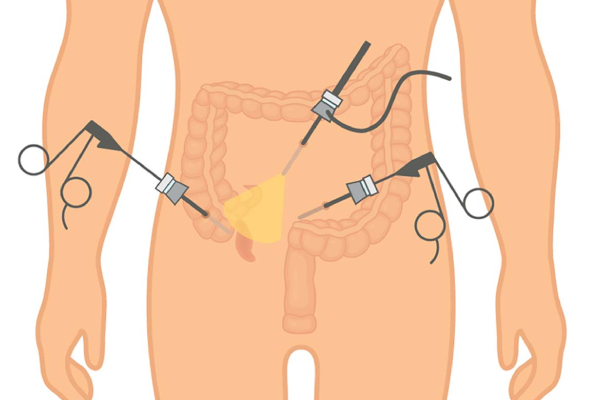 Laparoscopic-Appendix-Surgery-1