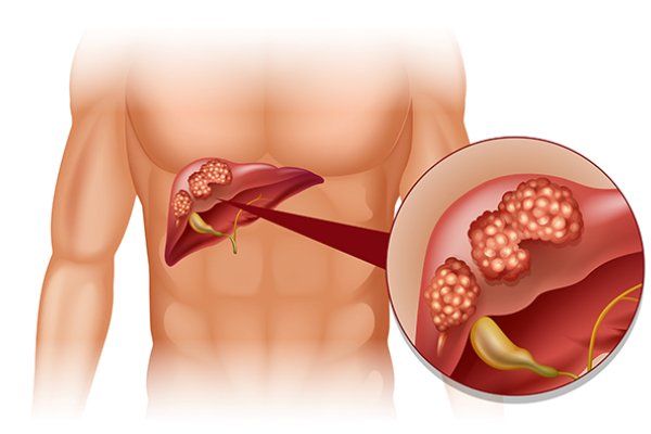 Liver-Tumor-1