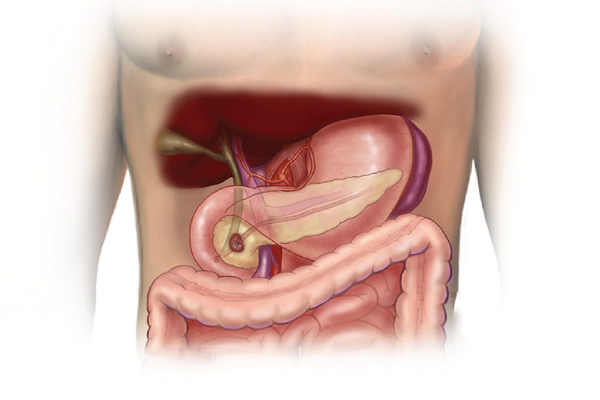 Pancreatectomy-1