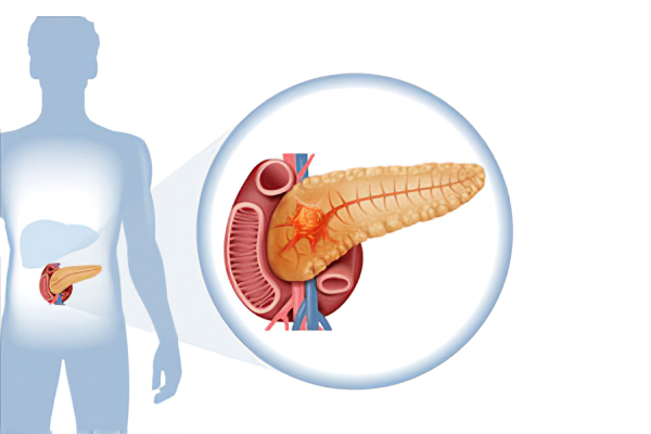 Pancreatic-cancer-1