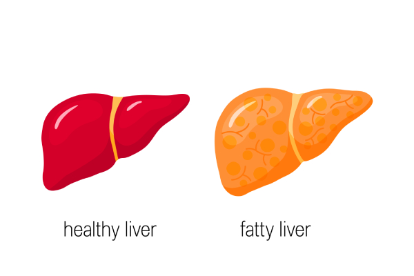 fatty-liver