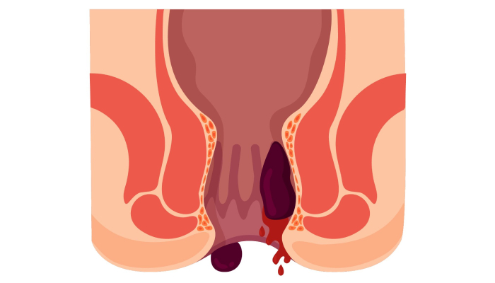 hemorrhoids-1