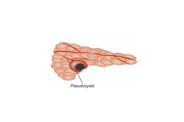 pseudocyst