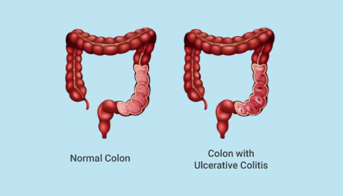 ulcerative-colitis-1